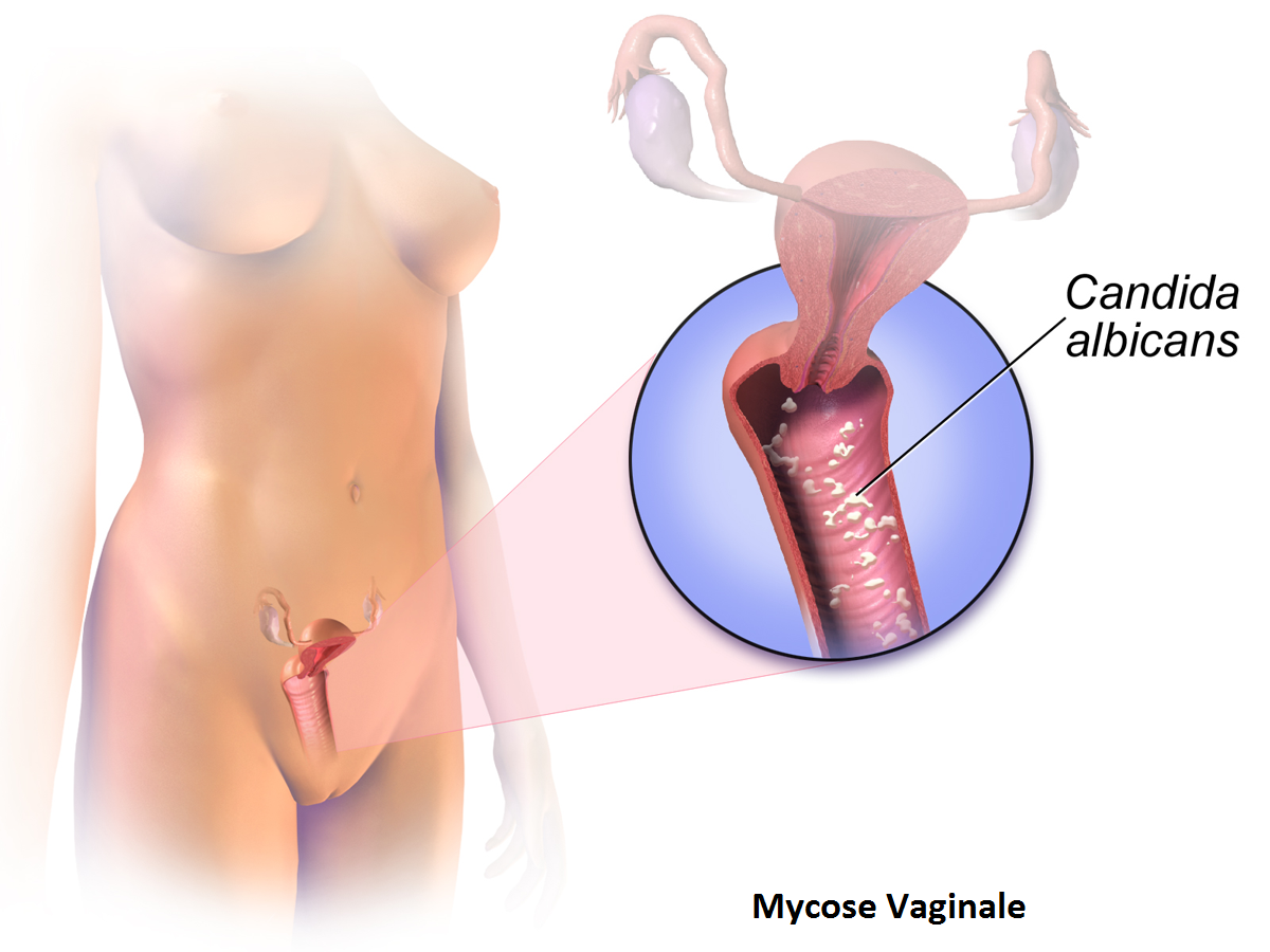 mycose vaginale neufmois fr